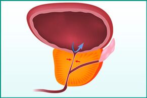 Prostate enlargement and urethral compression