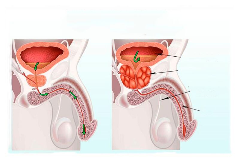 Standard and inflammation of the prostate
