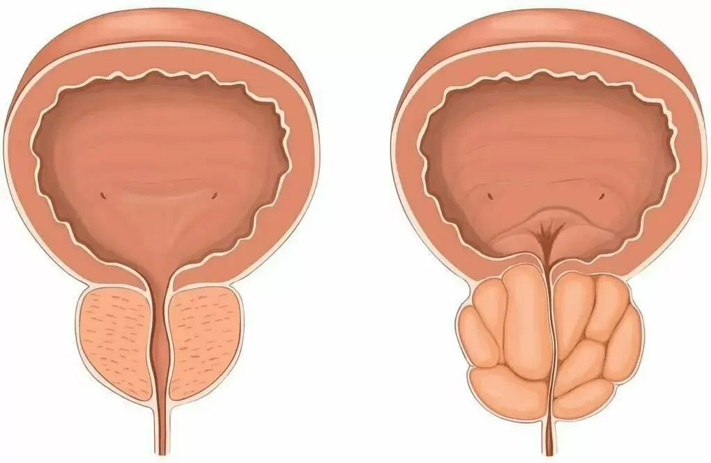 Normal prostate and painful prostate
